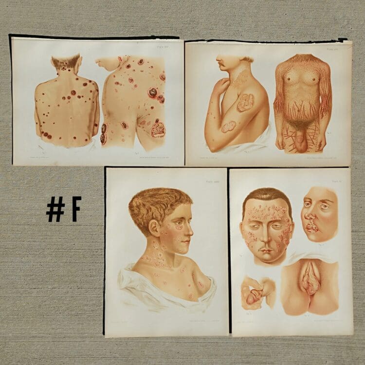 Antique Medical Plates, Vintage Medical Photos, 1889 Atlas of Skin and Venereal Diseases, Vintage Medical Posters