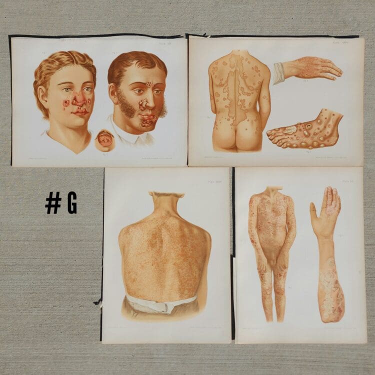 Antique Medical Plates, Vintage Medical Photos, 1889 Atlas of Skin and Venereal Diseases, Vintage Medical Posters