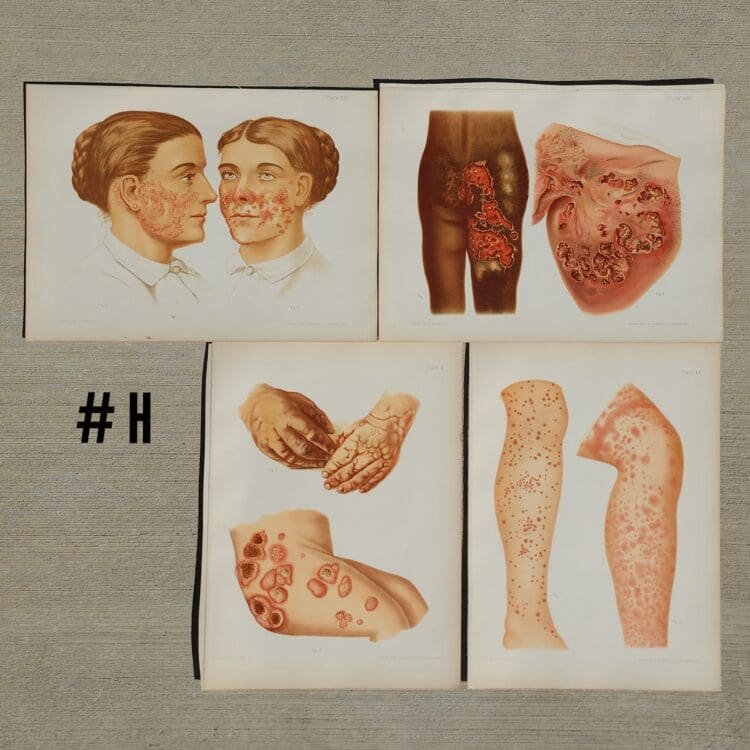 Antique Medical Plates, Vintage Medical Photos, 1889 Atlas of Skin and Venereal Diseases, Vintage Medical Posters