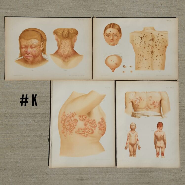 Antique Medical Plates, Vintage Medical Photos, 1889 Atlas of Skin and Venereal Diseases, Vintage Medical Posters