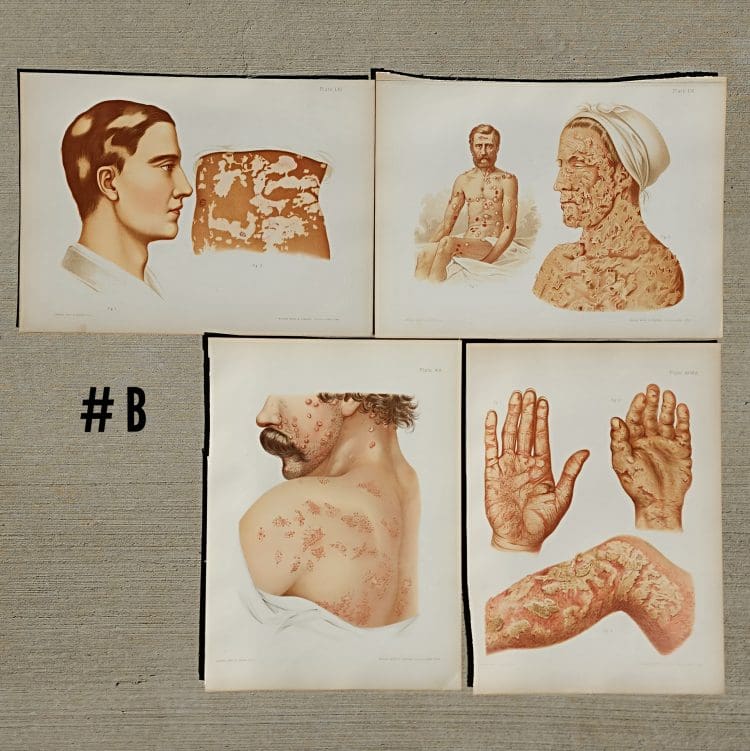 Antique Medical Plates, 1889 Atlas of Skin and Venereal Diseases, Large Medical Illustrations, Vintage Medical Prints