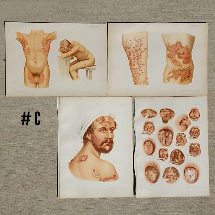 Antique Medical Plates, 1889 Atlas of Skin and Venereal Diseases, Large Medical Illustrations, Vintage Medical Prints