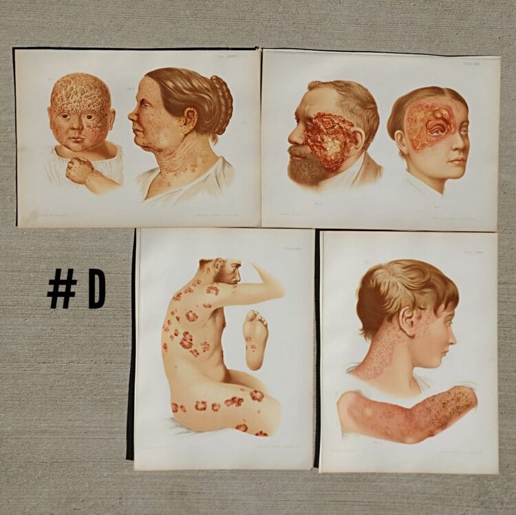 Antique Medical Plates, Vintage Medical Photos, 1889 Atlas of Skin and Venereal Diseases, Vintage Medical Posters